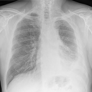 Digital chest x-ray of advanced malignant mesothelioma on left