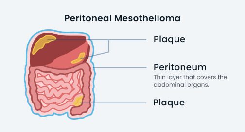 peritoneal mesothelioma diagram