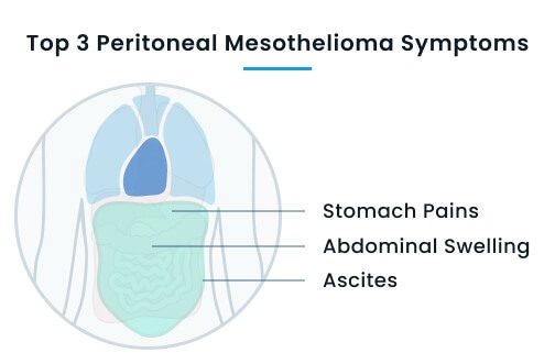 Top 3 peritoneal mesothelioma symptoms