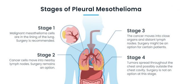 The four stages of pleural mesothelioma and their best treatments