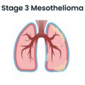 Stage 3 Mesothelioma Lung