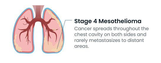 Stage 4 mesothelioma metastasis
